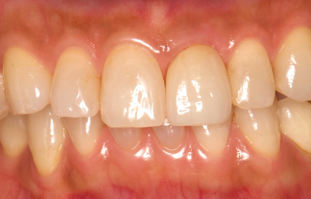 歯肉切除、ホワイトニング後セラミック治療した症例