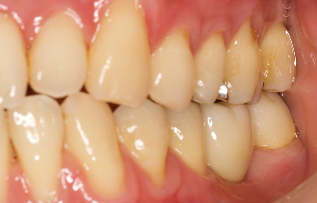 奥歯へのインプラント治療を行った症例