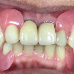 入れ歯（ノンクラスプデンチャー）の症例