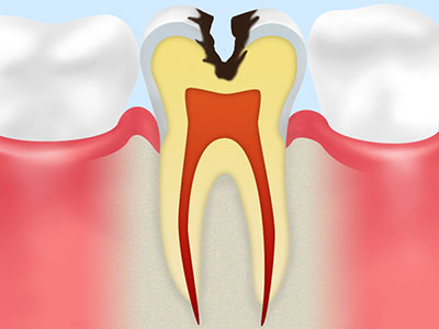 むし歯はこのように進行していきます