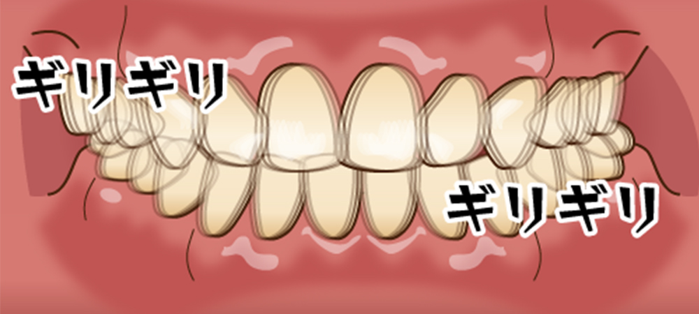 歯ぎしりが原因でおこるお口のトラブル