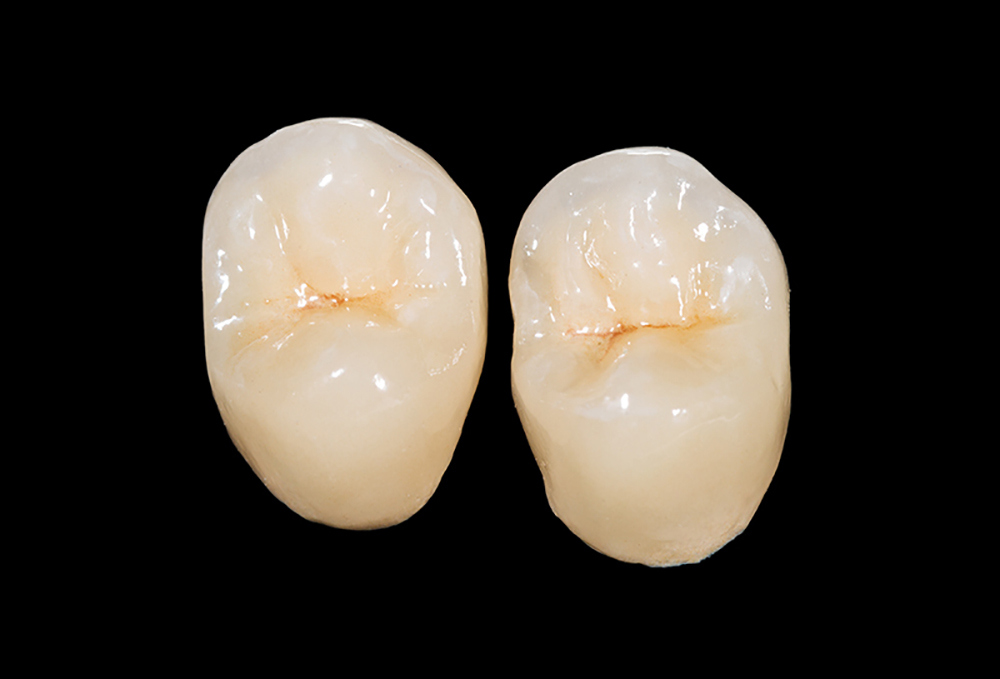 お口に合ったかぶせ物の作製