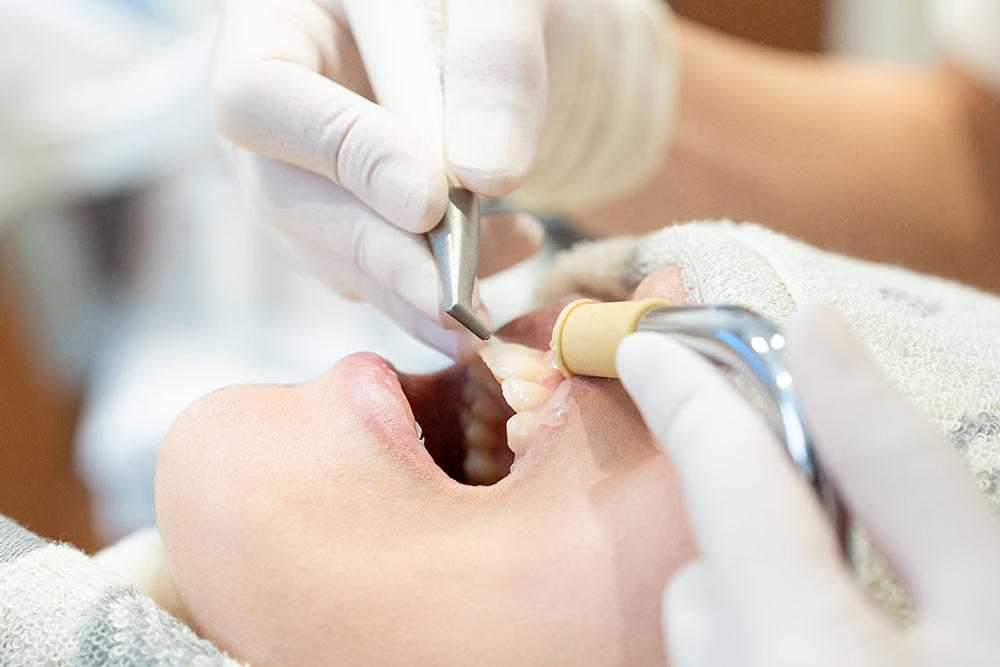 歯の表面をクリーニングします