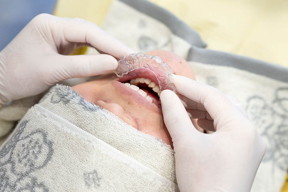 ホワイトニングトレーの完成