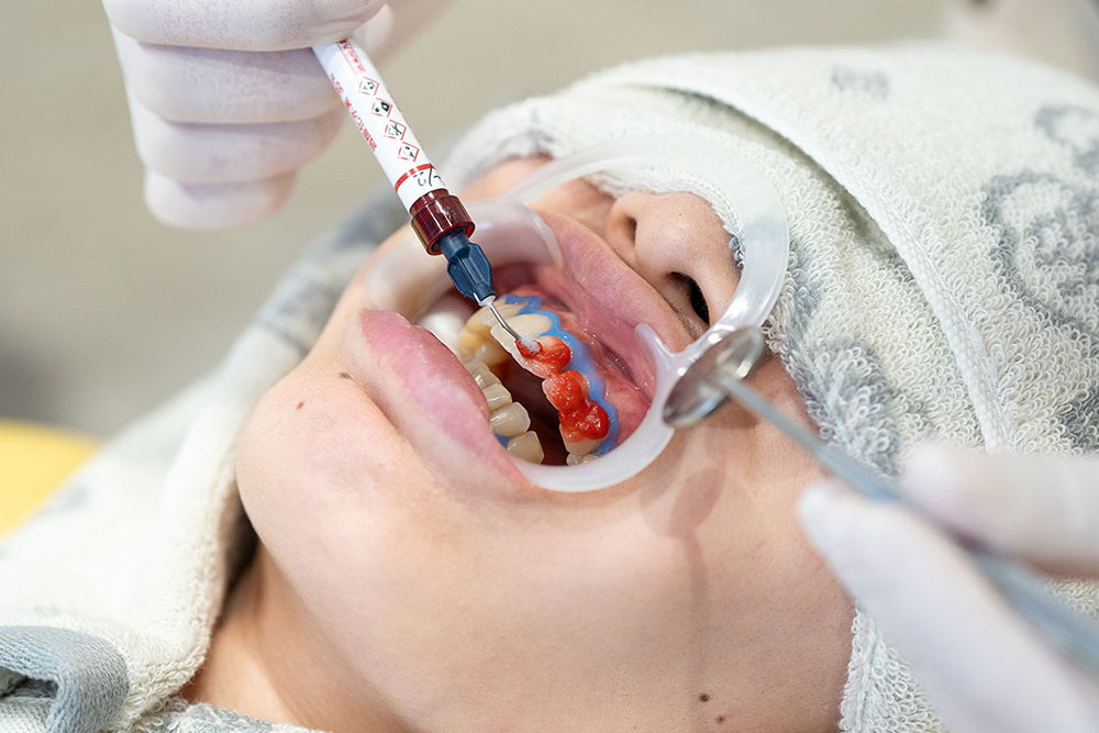 ホワイトニング剤の塗布